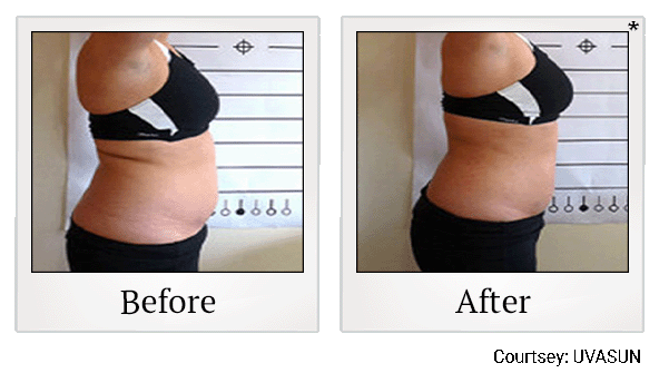 before and after female abdomen inches loss