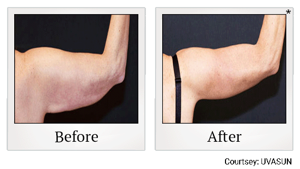 before and after arm