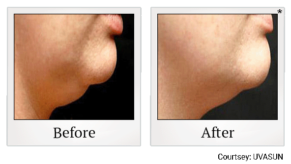 before and after chin