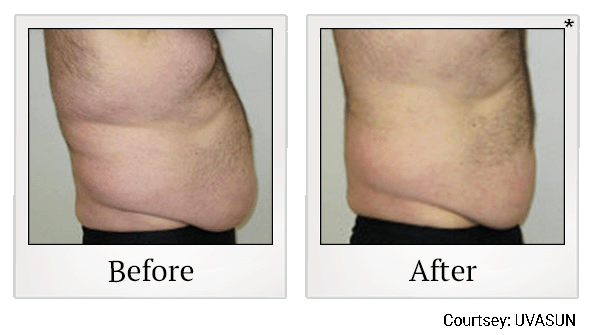 before and after male abdomen