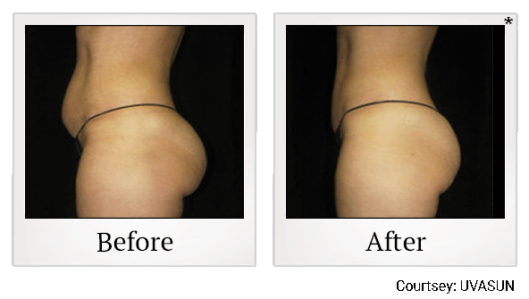 before and after female abdomen