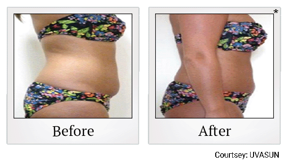 before and after female abdomen in bikini