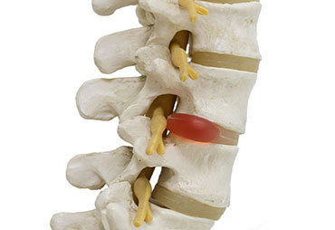 Herniated disc bulging in spinal cord